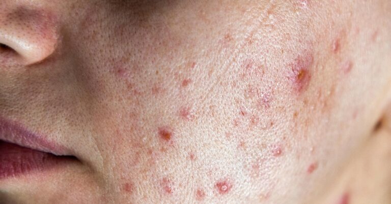 Hormonal Acne