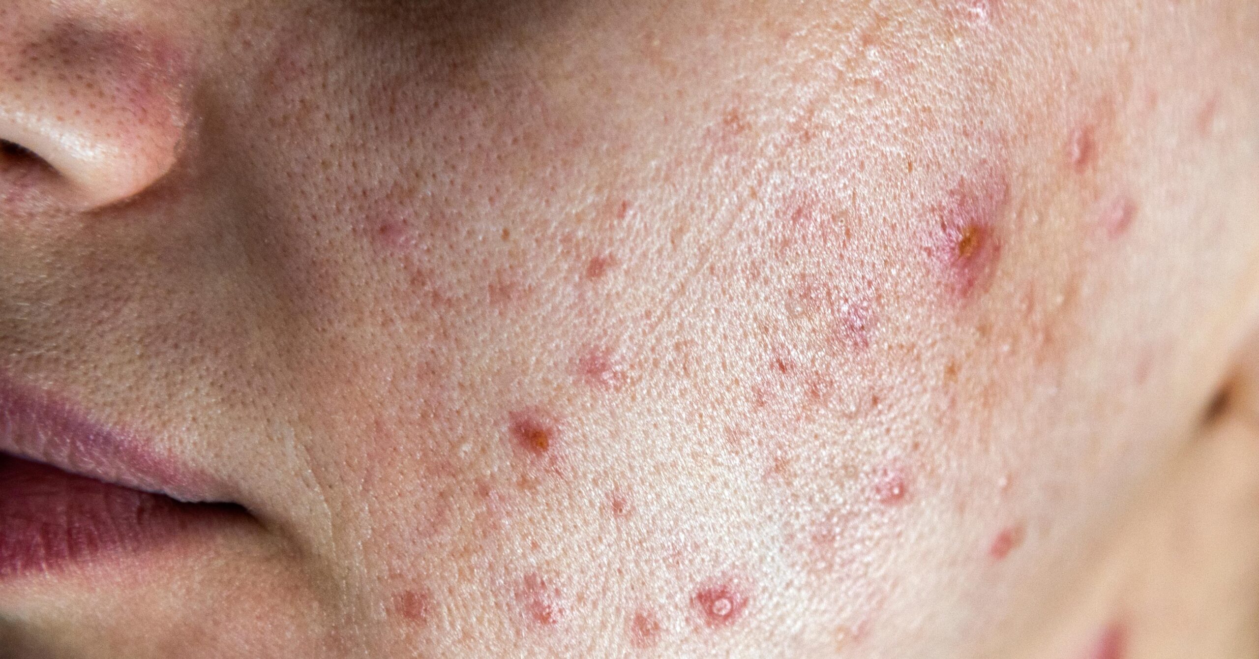 Hormonal Acne