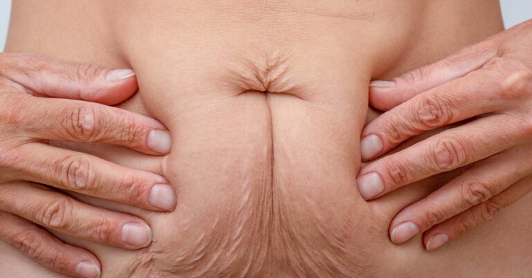 Cortisol Belly