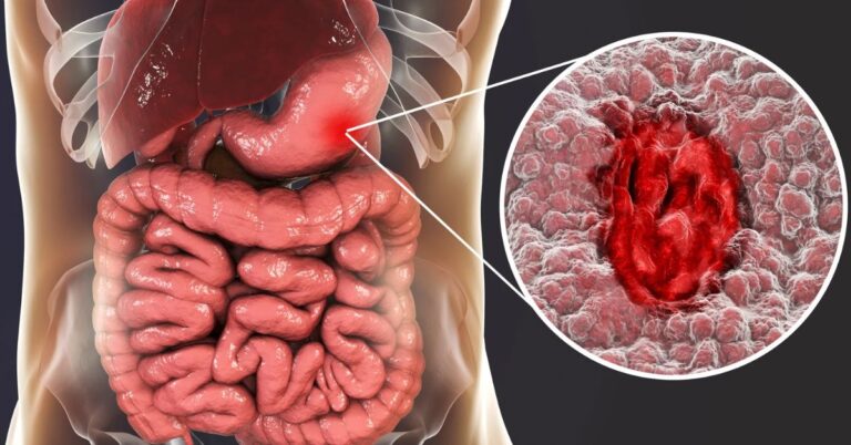 Daily Habits That Are Killing Your Gut Health