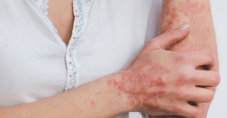 Lyme Disease Symptoms in 2025: Early Signs You Shouldn’t Ignore