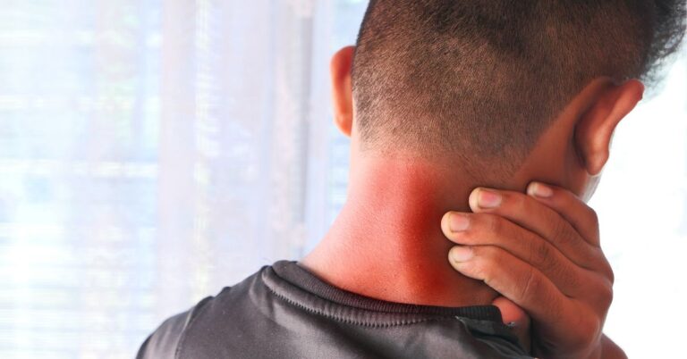 Lyme Disease Rash: What It Really Looks Like Early On